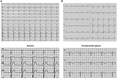 Case report: Lamin A/C gene mutation in patient with drug-induced type 1 Brugada syndrome at high arrhythmic risk